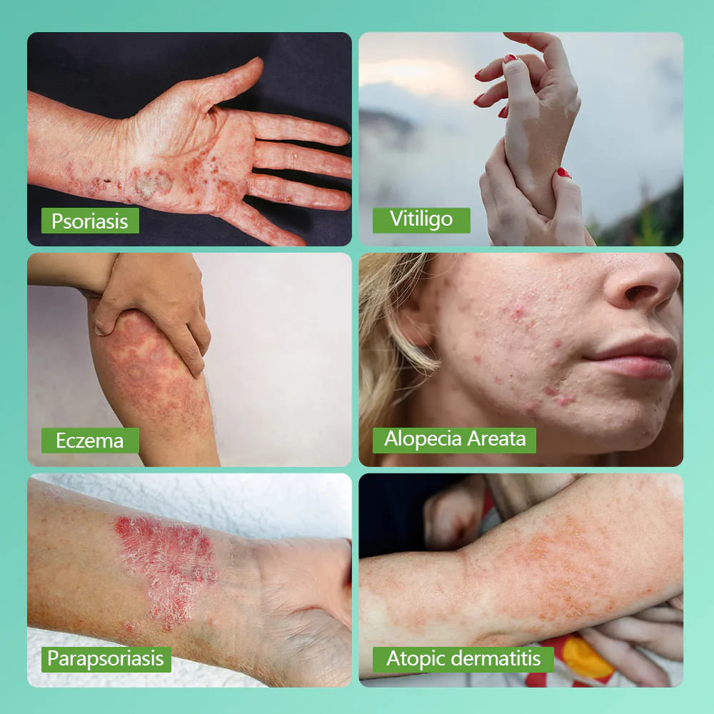 Philips Narrowband UVB Phototherapy Panel - Medical Grade 311nm Light Therapy for Vitiligo & Psoriasis Treatment at Home