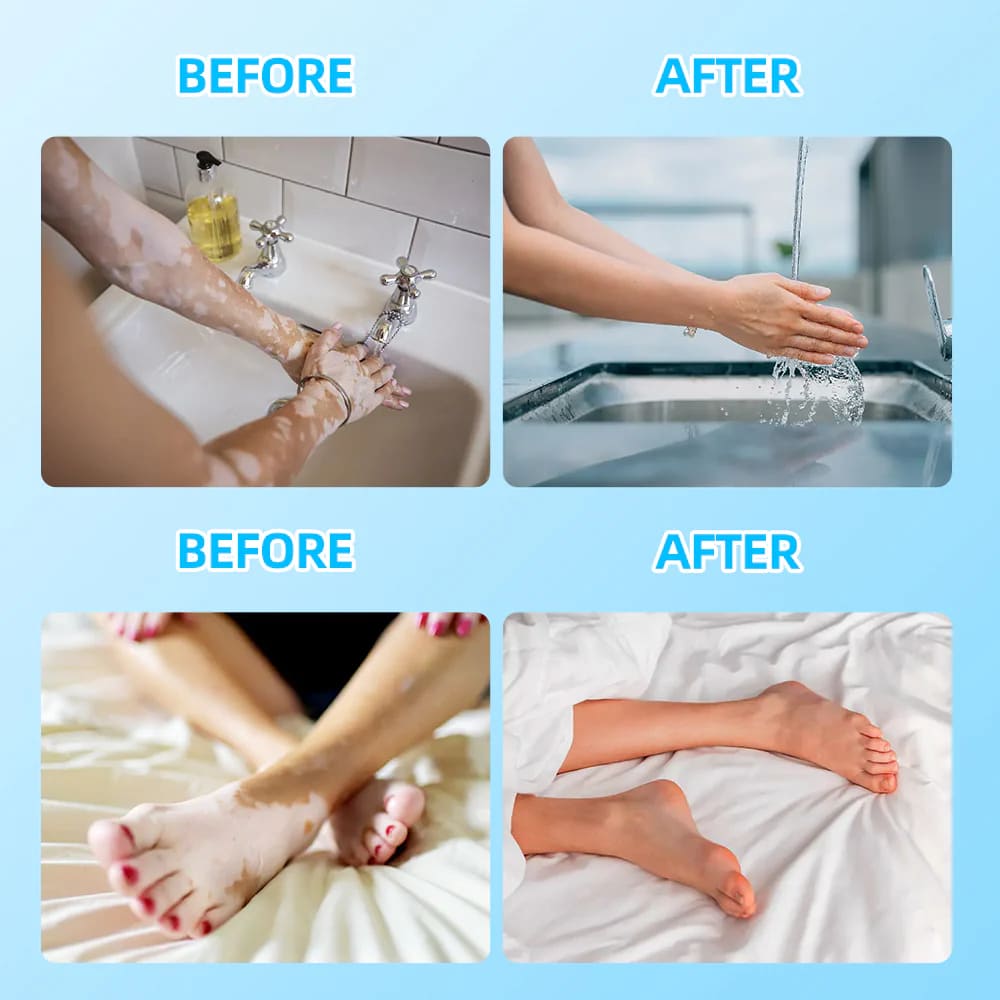 Targeted 308nm Excimer Lamp for Vitiligo & Psoriasis - Focused UVB Phototherapy Device for Home Use
