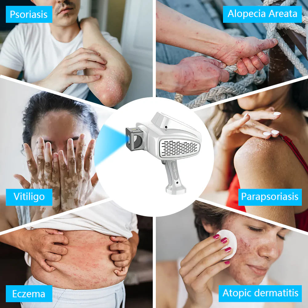 Targeted 308nm Excimer Lamp for Vitiligo & Psoriasis - Focused UVB Phototherapy Device for Home Use
